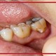 آیا پوسیدگی دندان با دارو درمان می‌شود؟ واقعیت یا تبلیغ؟